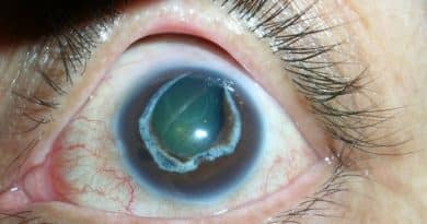 Tratamento de Glaucoma: Guia Completo para uma Visão Saudável
